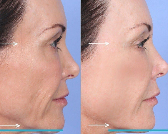 Preenchimento com Sculptra Face e Corpo